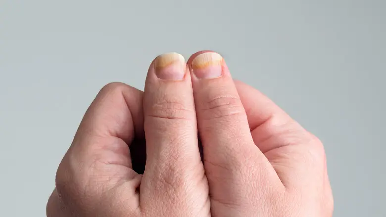 Is Nail Biting Harmful to Mental and Physical Health